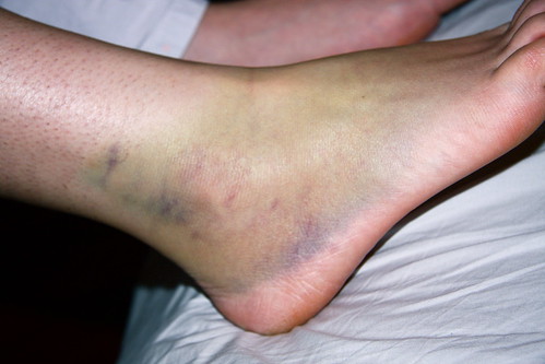 Bruised Ankle