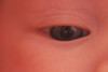 Nora Right Eye